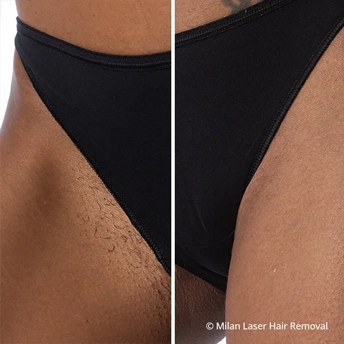 Kijker Supplement Bloeien Before & After Photos of Laser Hair Removal | Milan Laser