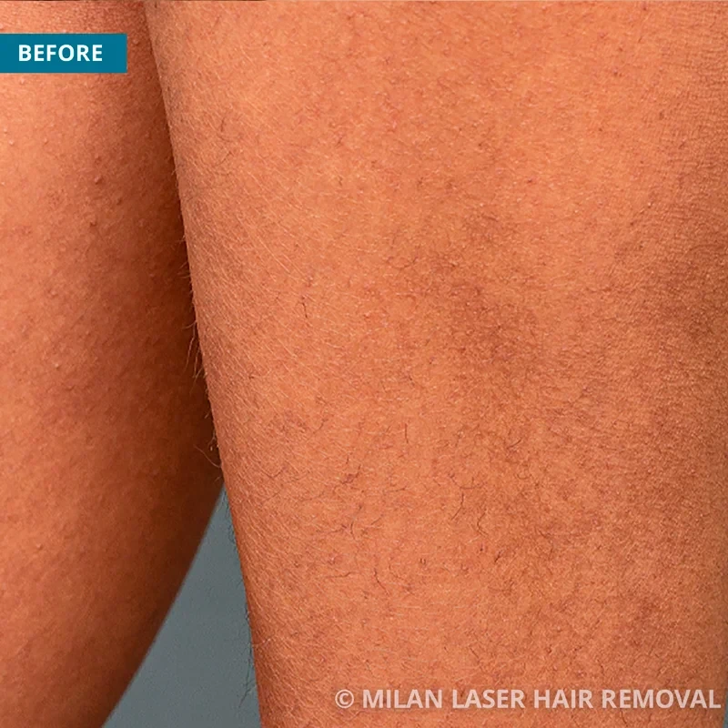 legs-and-feet-before-after-photos-of-laser-hair-removal-milan-laser